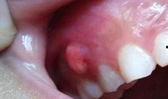 舌头溃疡可以吃凉瓜,缓解舌头溃疡困扰